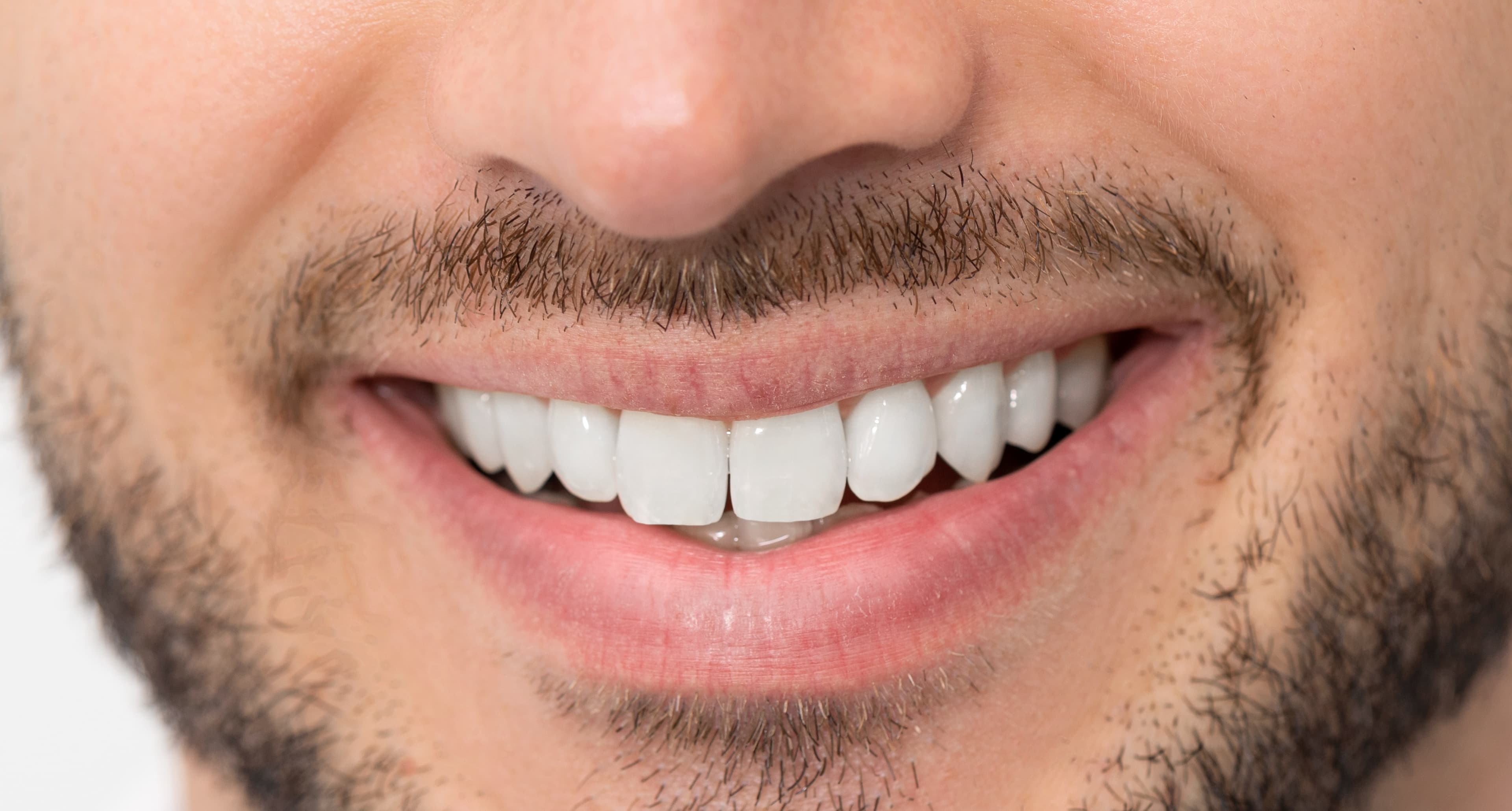 After: Clinical illustration showing potential tooth whitening results of 6-8 shades improvement.
