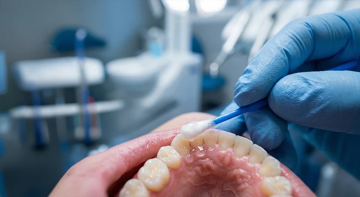 Gentle anaesthesia application for comfortable wisdom tooth removal.