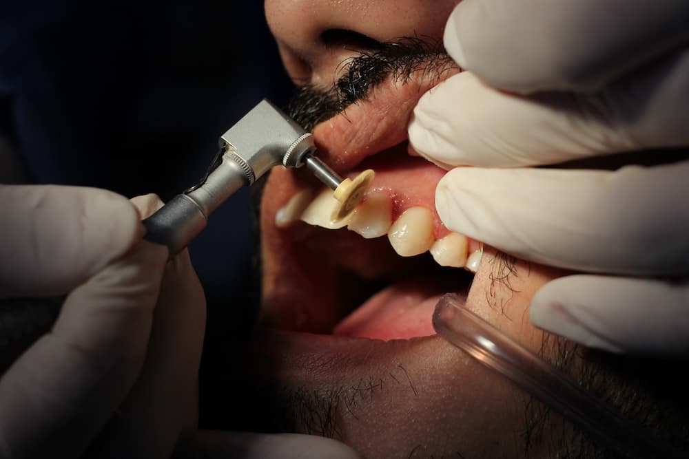 Dental clinician polishing composite resin with fine-grit discs for natural enamel-like finish.