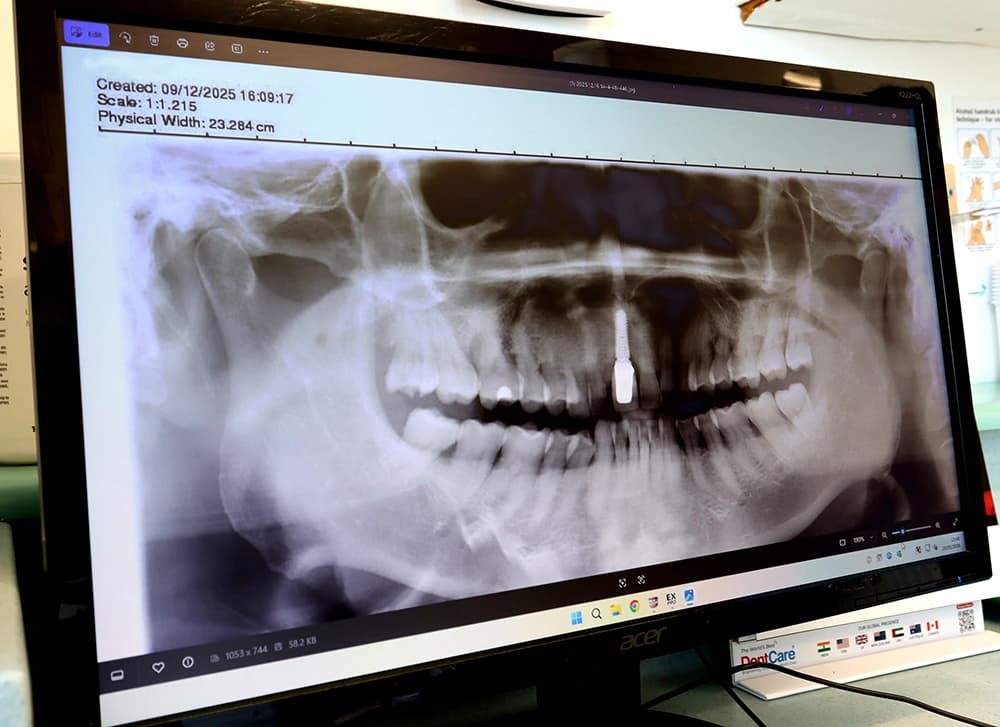 A high-definition dental X-ray used for mapping bone health and monitoring restorations.