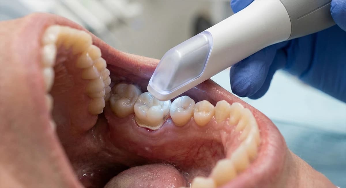 Advanced intraoral scanner capturing precise 3D digital impressions for Invisalign treatment planning.