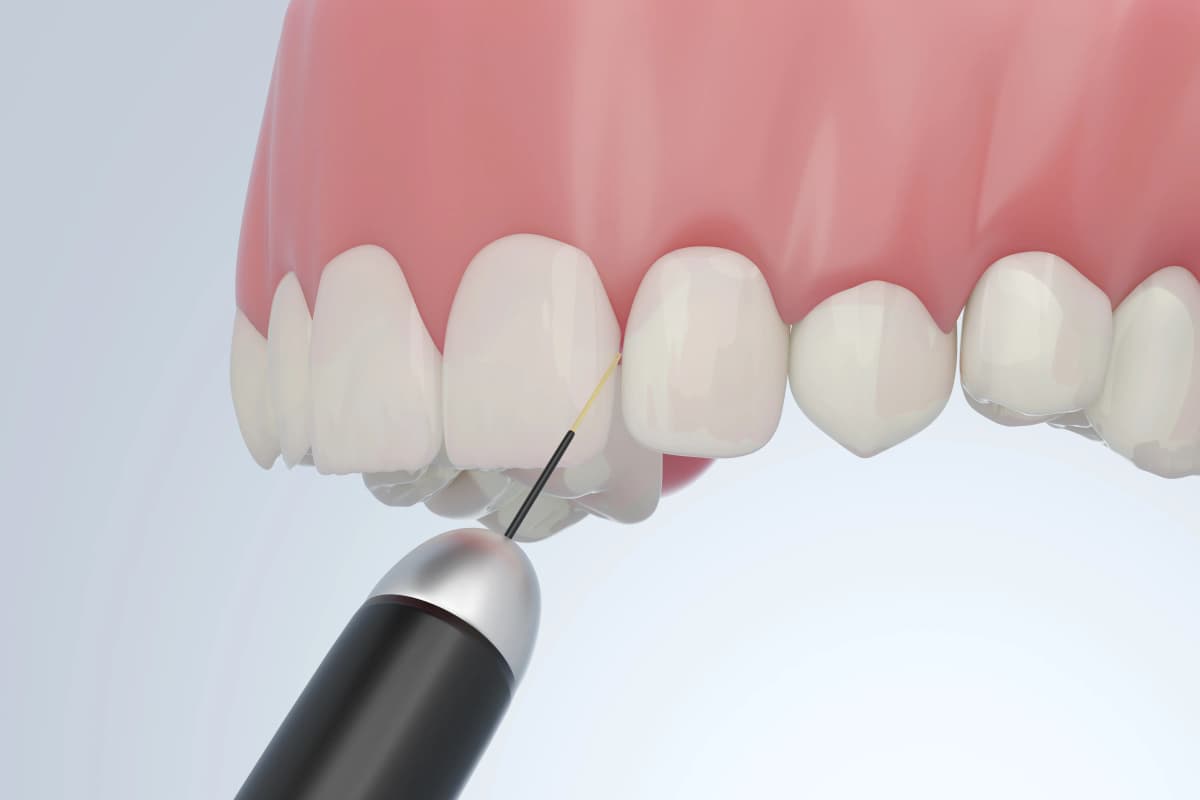 Dental Contouring