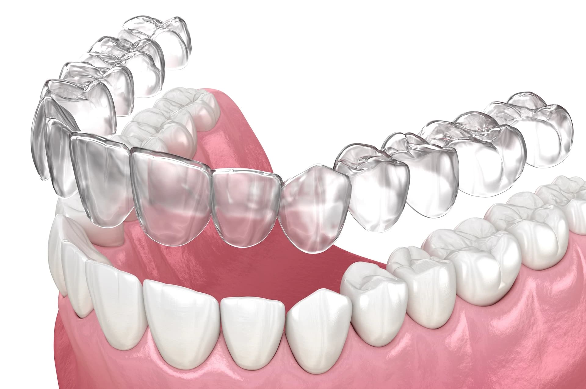 Invisalign clear aligners treatment at Maypole Dental Surgery