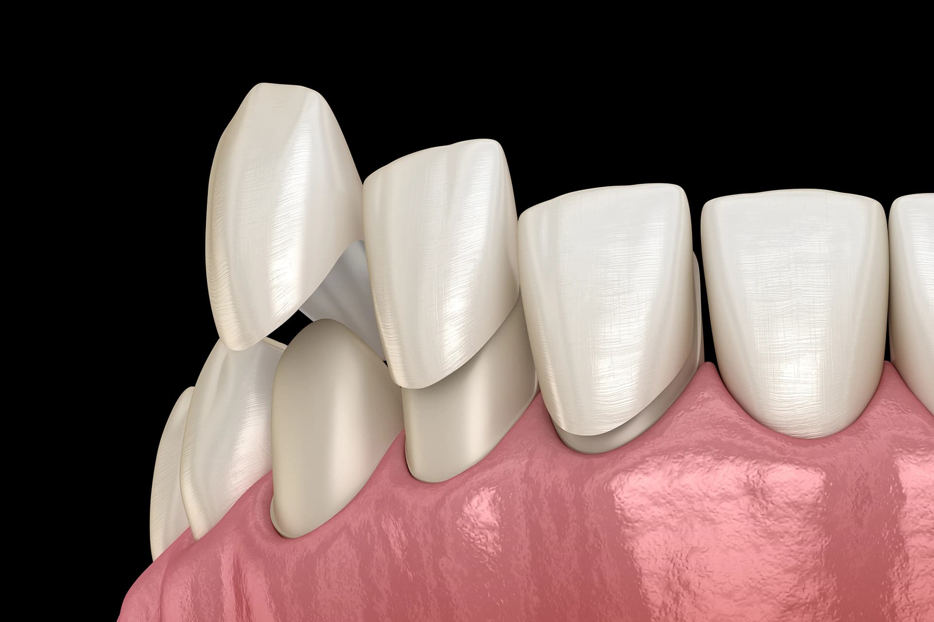 Veneers treatment at Maypole Dental Surgery