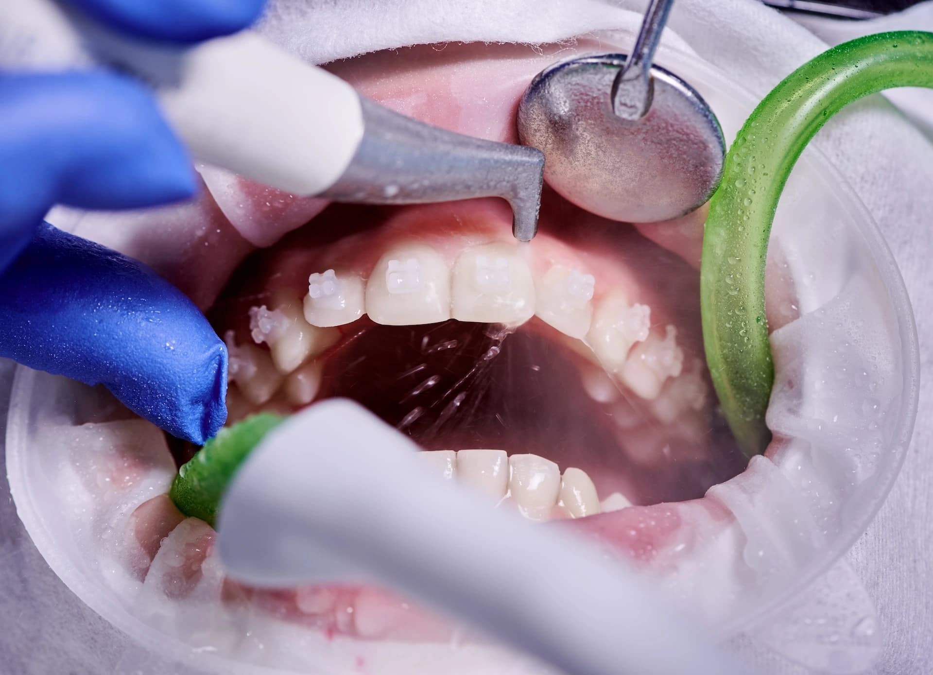 Airflow Polishing treatment at Maypole Dental Surgery