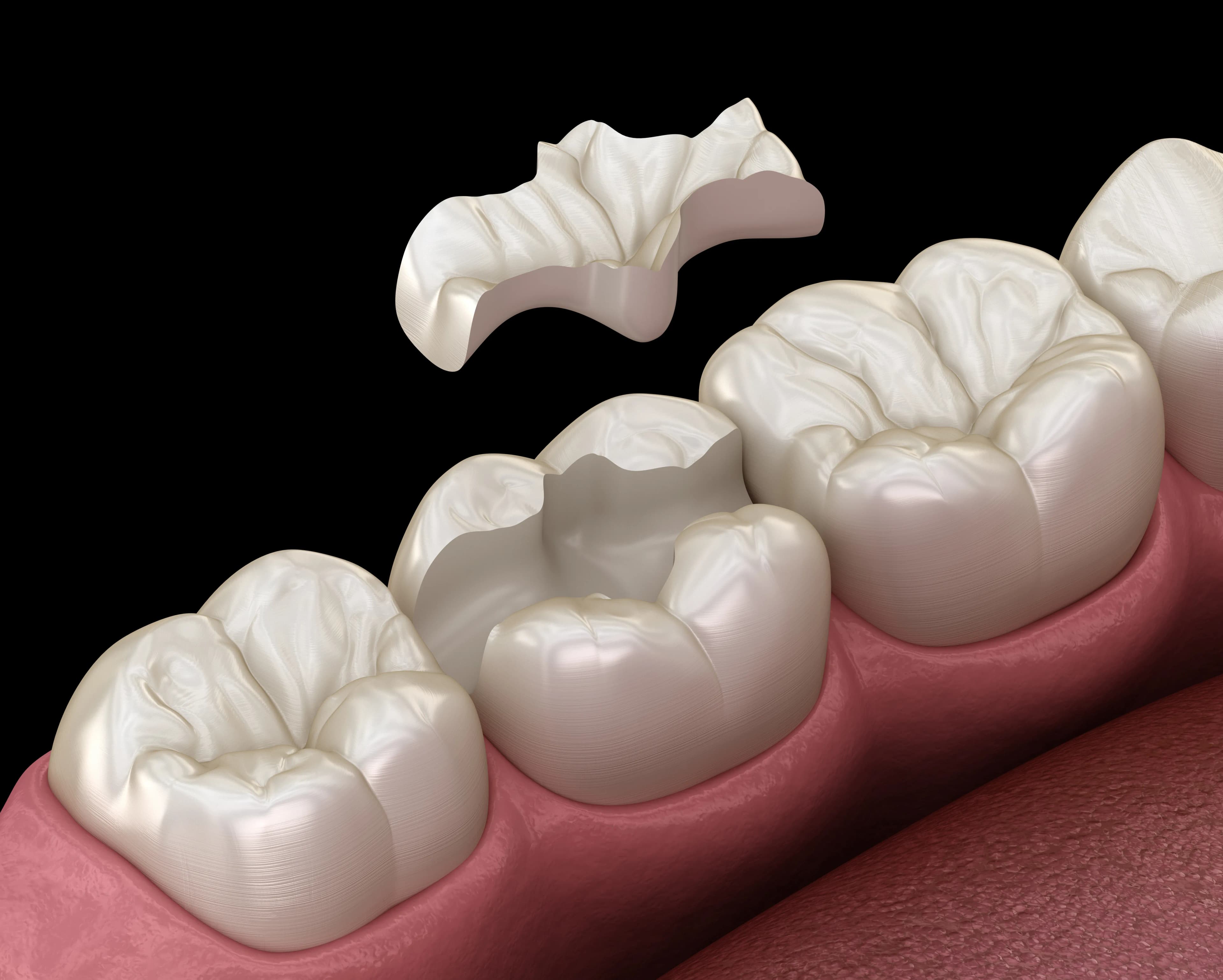 Inlays/Onlays treatment at Maypole Dental Surgery