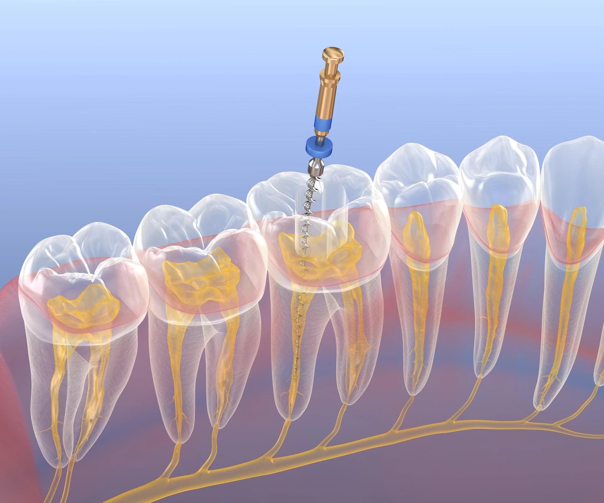 Root Canal treatment at Maypole Dental Surgery