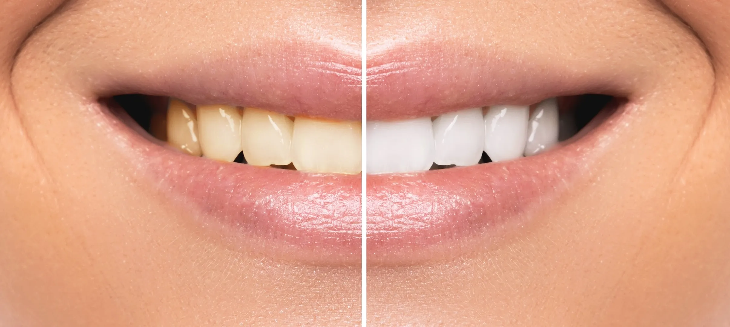 Tooth Whitening treatment at Maypole Dental Surgery