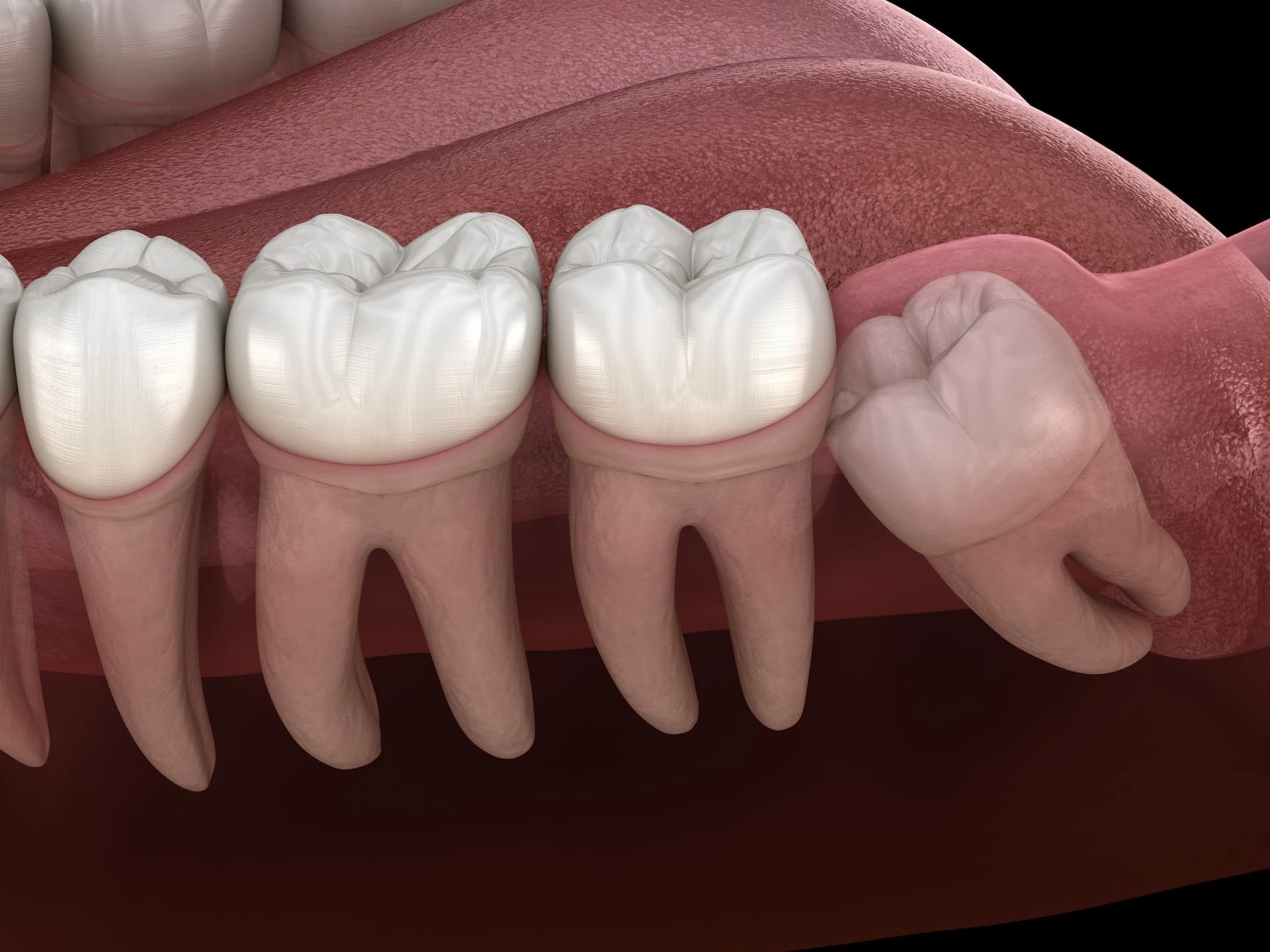 Wisdom Teeth Removal treatment at Maypole Dental Surgery