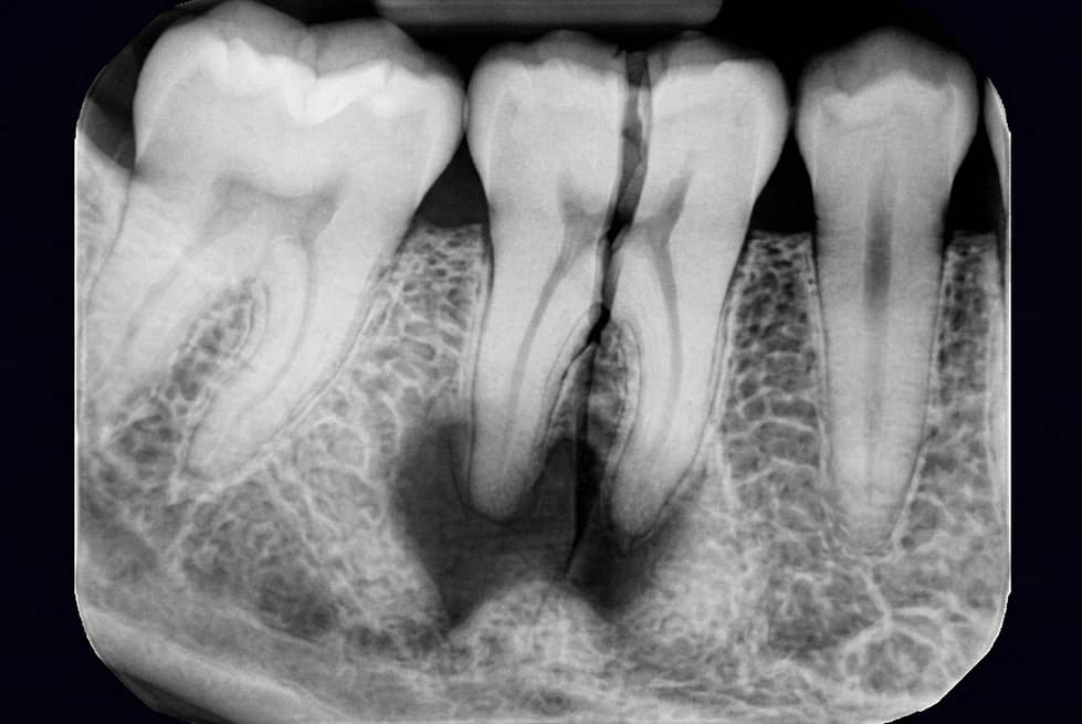 Digital periapical X-ray showing detailed root structure for surgical extraction planning.