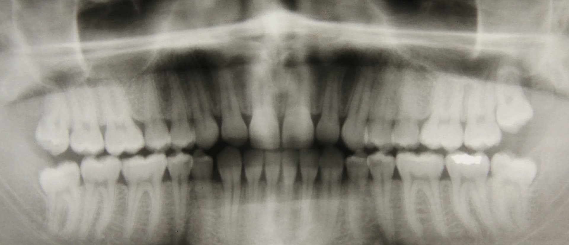 Digital panoramic X-ray showing detailed dental structures for emergency diagnosis.
