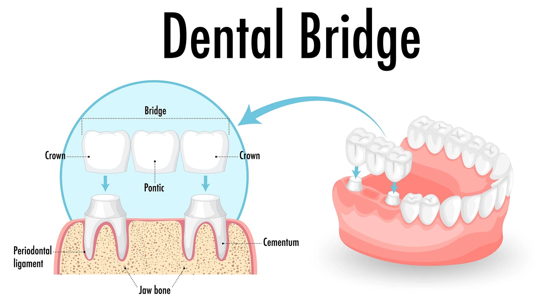 Detailed dental bridge anatomy diagram showing crown, pontic, cementum, periodontal ligament, and jaw bone structure for Maypole Dental educational purposes