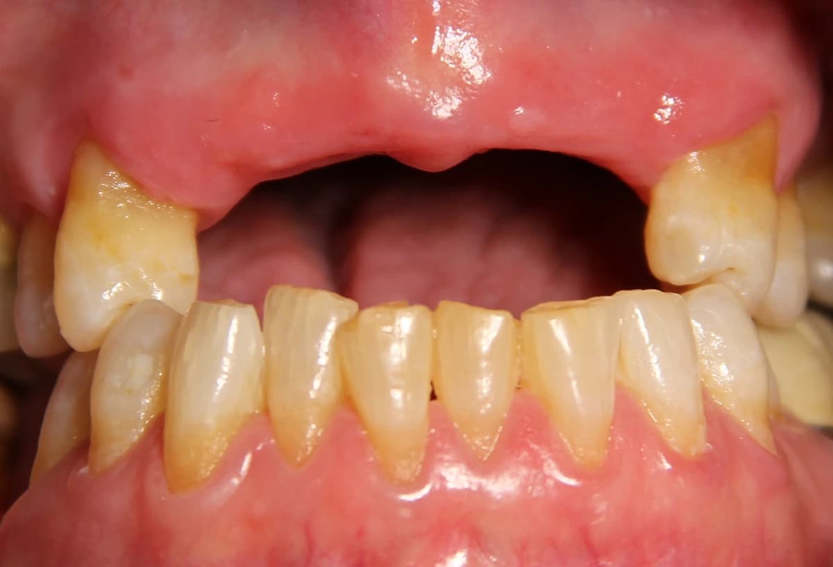 Before: Before and after denture transformation showing full smile restoration at Maypole Dentistry.