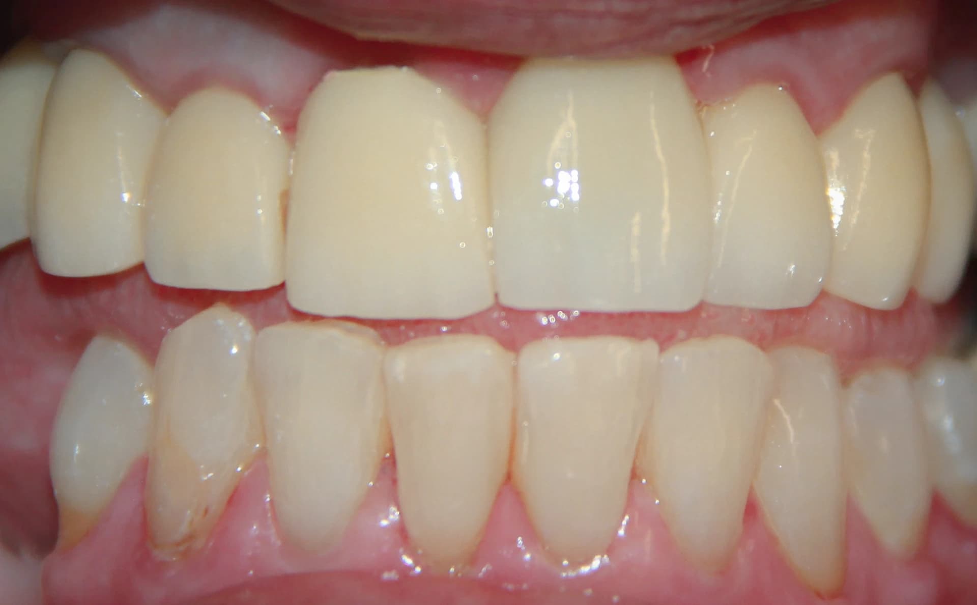 After upper arch rehabilitation — restored smile with porcelain bridge and veneers at Maypole Dental Surgery Birmingham
