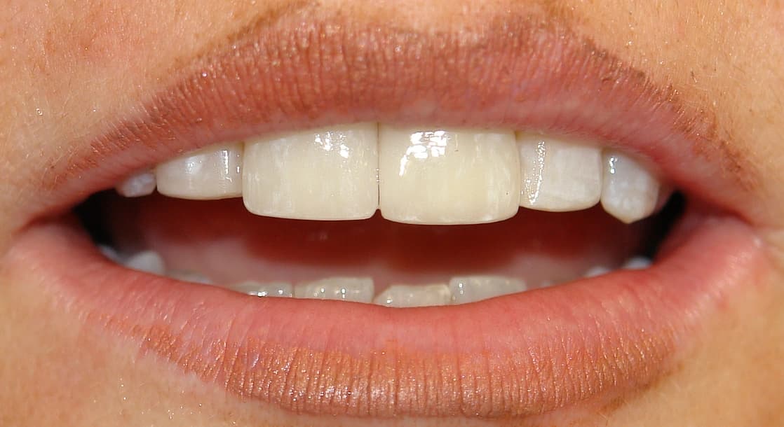After: Before and after porcelain veneers for internal staining and spacing correction at Maypole Dentistry.