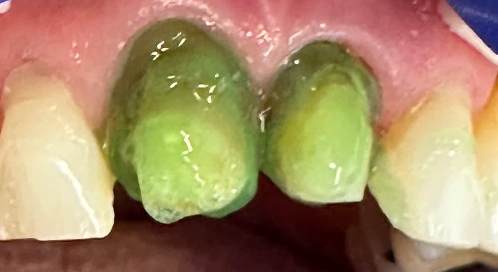 Clinical application of dental conditioning gel for high-strength porcelain crown bonding.