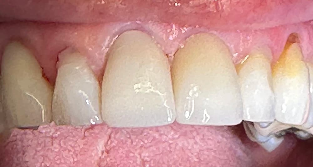After: Clinical case showing replacement of failing dental crowns with precision-fit porcelain to correct marginal recession and leakage.