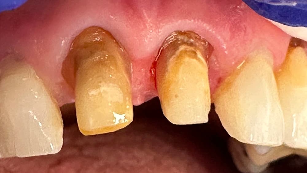 Close-up of precision dental crown preparation stumps showing structural foundation.