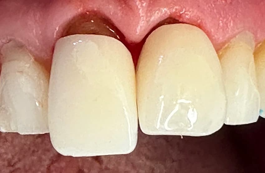 Before: Clinical case showing replacement of failing dental crowns with precision-fit porcelain to correct marginal recession and leakage.