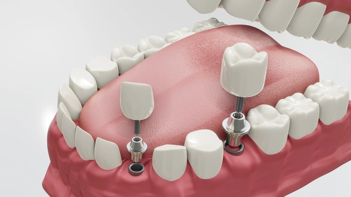 Implants