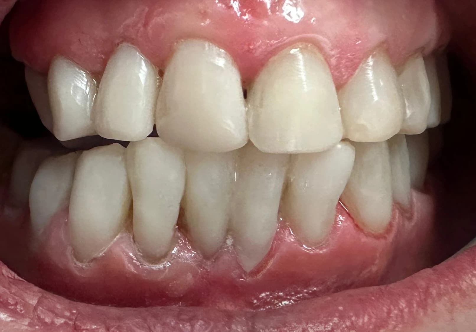 After: Before and after composite bonding and teeth whitening transformation showing restored tooth structure and natural smile.