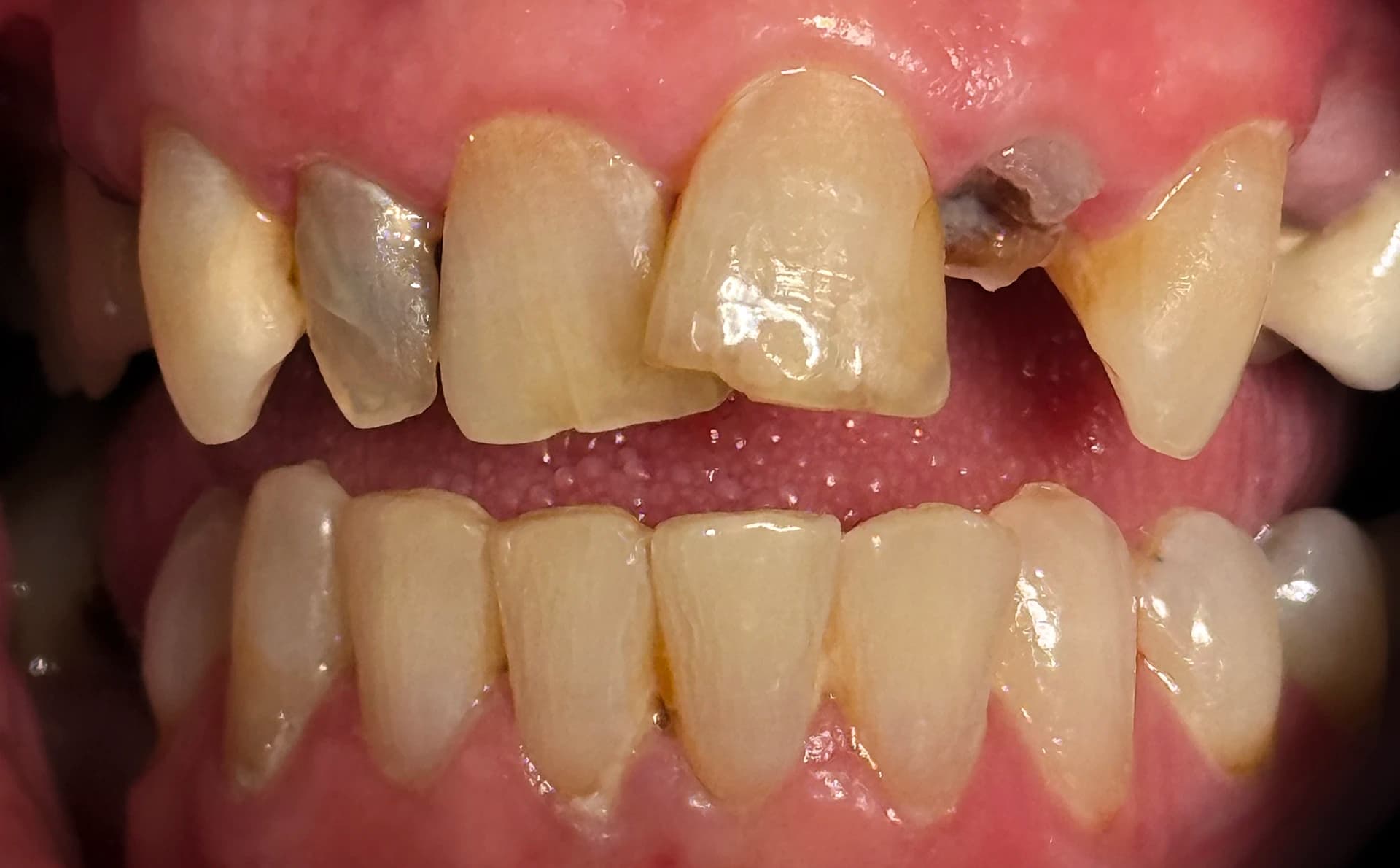 Before upper arch rehabilitation — dental wear and broken teeth at Maypole Dental Surgery Birmingham