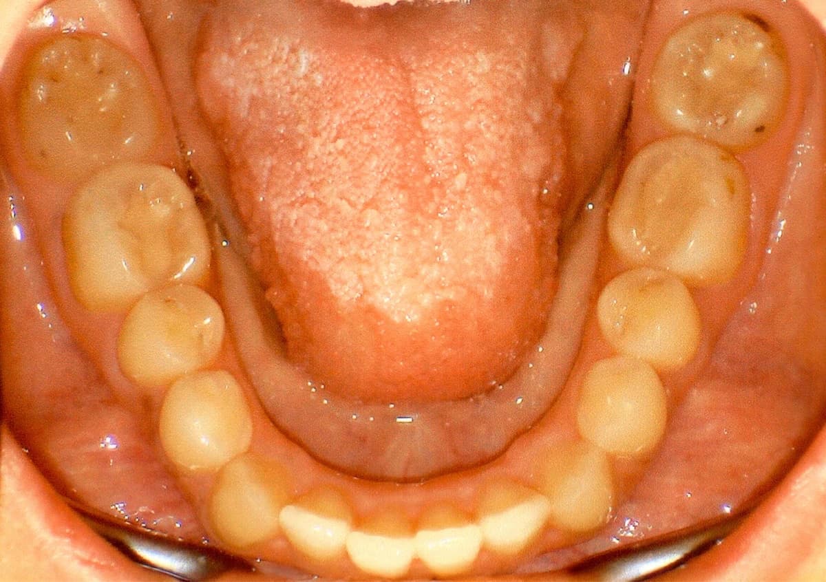 Clinical view of lower arch realignment and rotation correction via Invisalign.