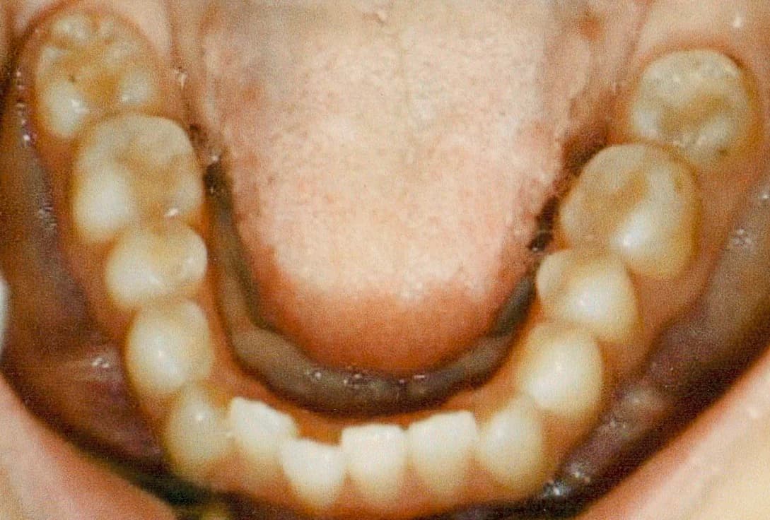 Clinical view of lower arch before Invisalign realignment.