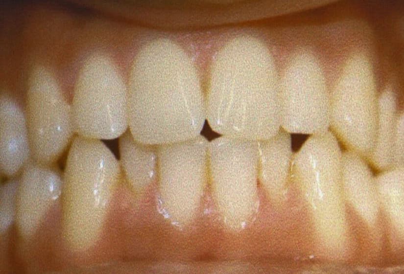 Before: Invisalign before and after results for severe lower crowding and tooth rotation correction.