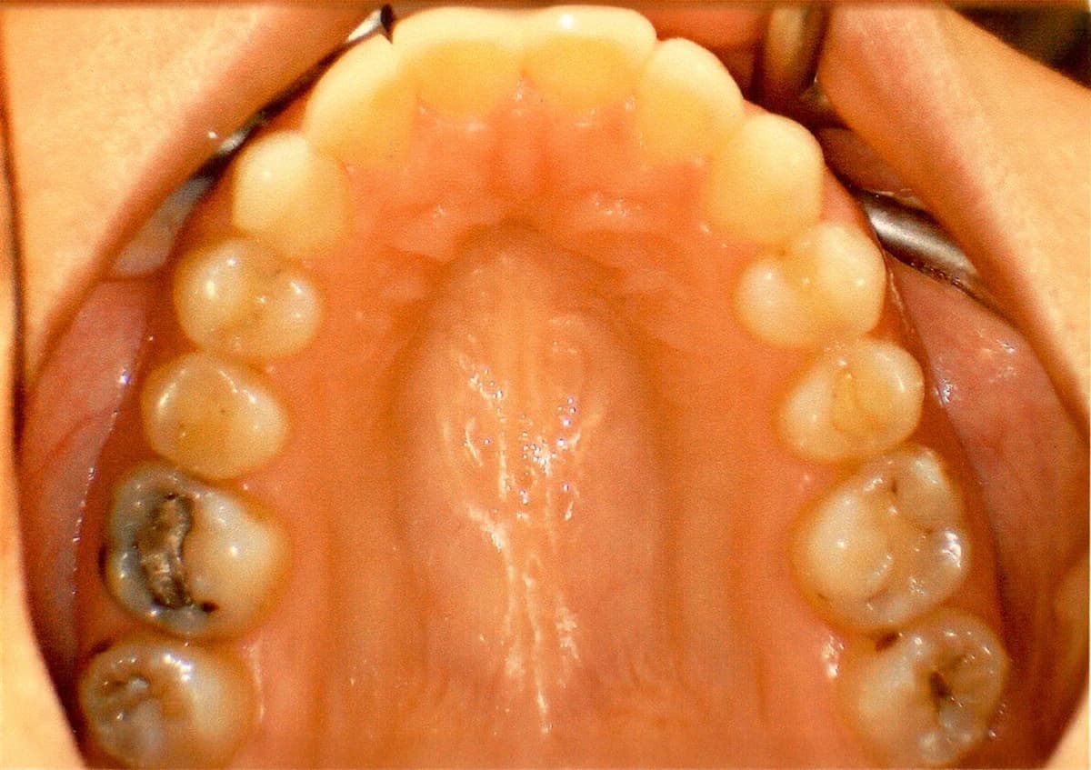 Clinical view of upper palatal expansion results using Invisalign clear aligners.