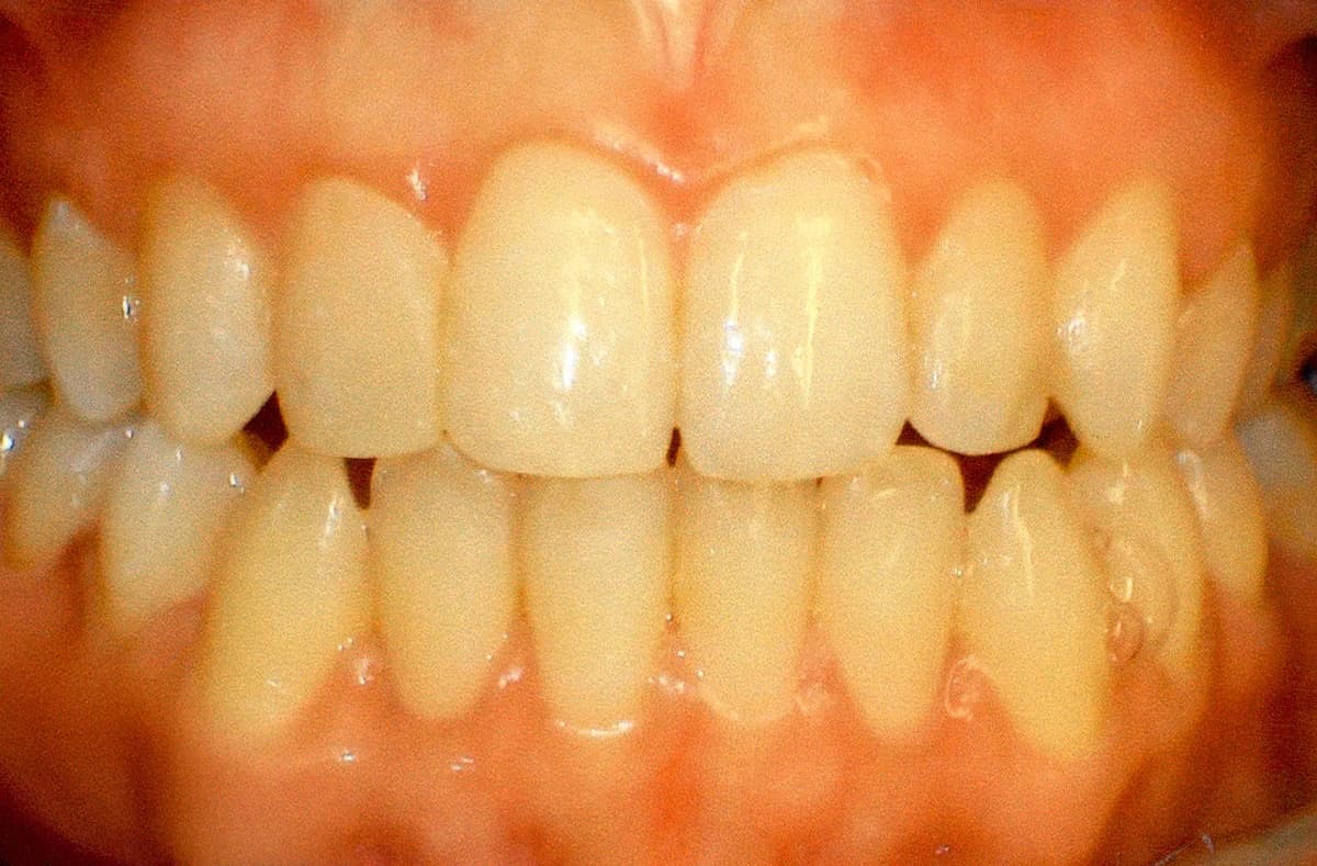 After: Invisalign before and after results for a wedding smile transformation showing anterior alignment.