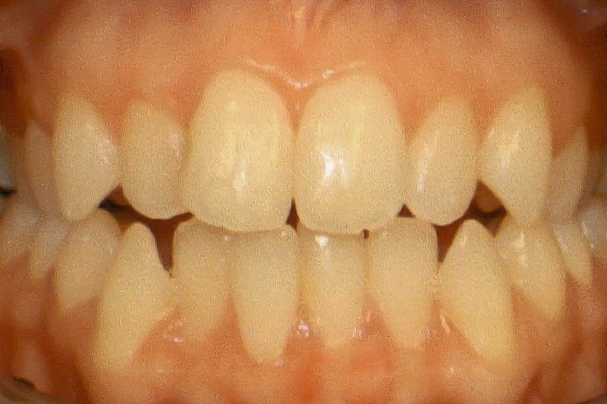 Before: Invisalign before and after results for a wedding smile transformation showing anterior alignment.