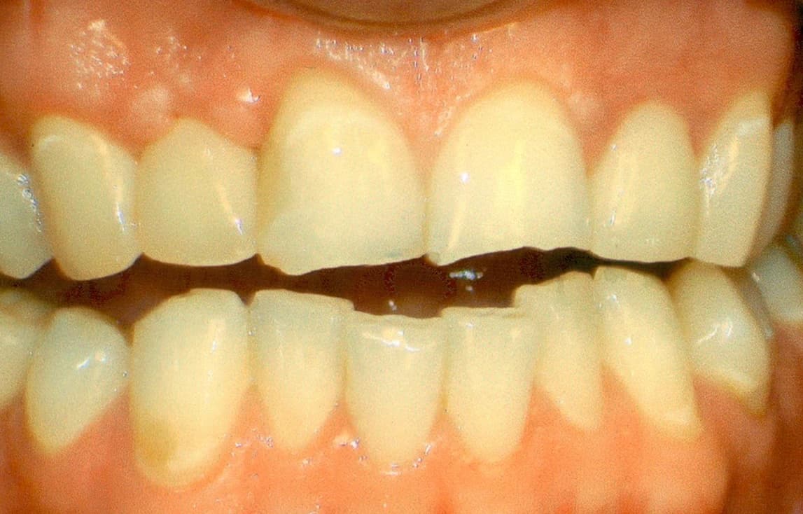 After: Before and after dental implant restoration following sports injury at Maypole Dentistry.