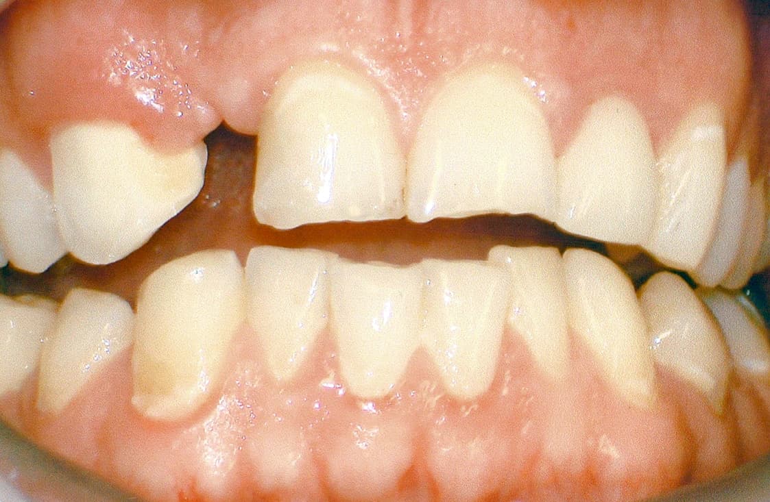 Before: Before and after dental implant restoration following sports injury at Maypole Dentistry.